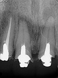 抜歯しない治療 症例1　再治療ケース