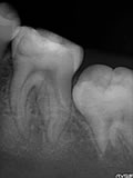 抜歯しない治療 症例15 抜髄根管