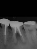抜歯しない治療 症例18 パーフォレーションリペアー