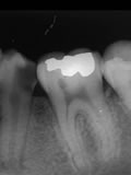 抜歯しない治療 症例22 アペキシフィケーション下顎小臼歯