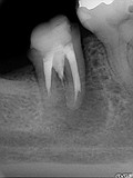 抜歯しない治療 症例3　根管内に穿孔が存在するケース