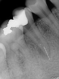 抜歯しない治療 症例5　治療用器具破折の除去ケース