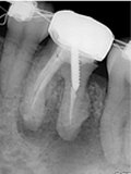抜歯しない治療 症例8 矯正治療のアクシデントにおけるハイパー根管治療の効果