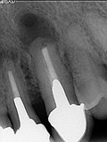 抜歯しない治療 症例9 外科的歯内療法を行なったケース